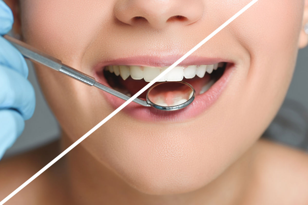Professional Teeth Whitening Cost